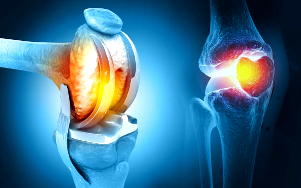 Knee Replacement Surgery